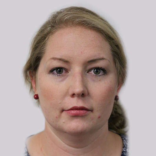 Dr Ha Blepharoplasty (Eyelid Surgery) Before & After - Adelaide