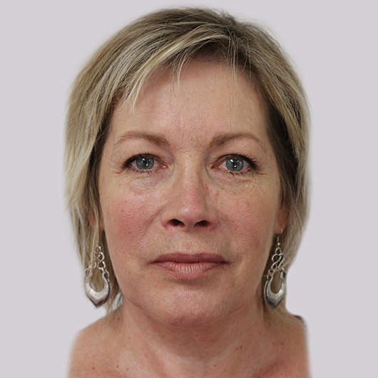 Dr Ha Blepharoplasty (Eyelid Surgery) Before & After - Adelaide