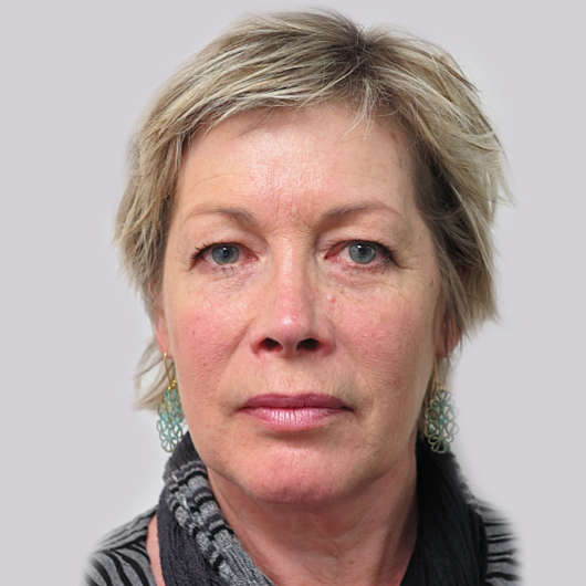 Dr Ha Blepharoplasty (Eyelid Surgery) Before & After - Adelaide