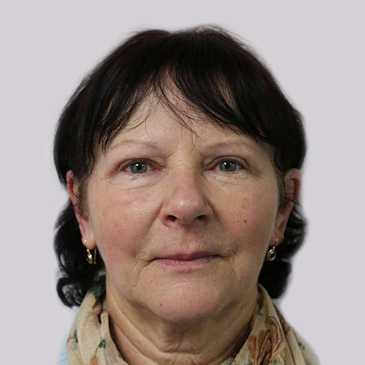 Dr Ha Blepharoplasty (Eyelid Surgery) Before & After - Adelaide