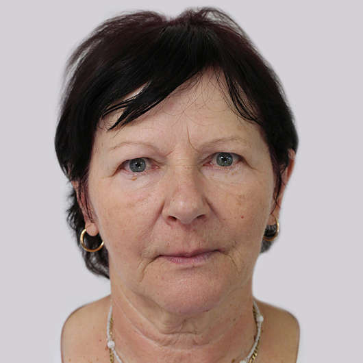 Dr Ha Blepharoplasty (Eyelid Surgery) Before & After - Adelaide