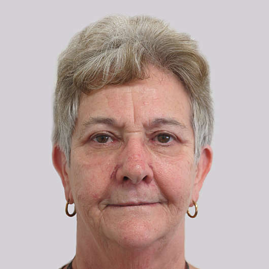 Dr Ha Blepharoplasty (Eyelid Surgery) Before & After - Adelaide