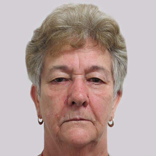 Dr Ha Blepharoplasty (Eyelid Surgery) Before & After - Adelaide