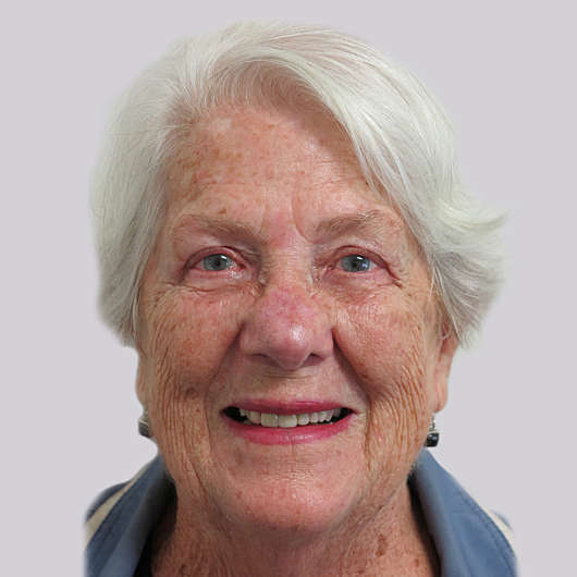 Dr Ha Blepharoplasty (Eyelid Surgery) Before & After - Adelaide