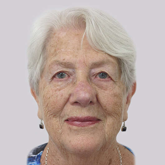 Dr Ha Blepharoplasty (Eyelid Surgery) Before & After - Adelaide