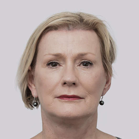 Dr Ha Facelift Before & After - Adelaide
