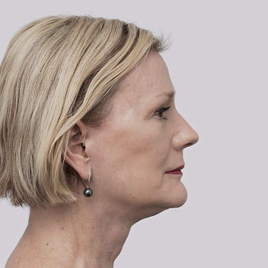 Dr Ha Facelift Before & After - Adelaide