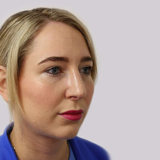 Dr Ha Rhinoplasty Before & After (Female) - Adelaide