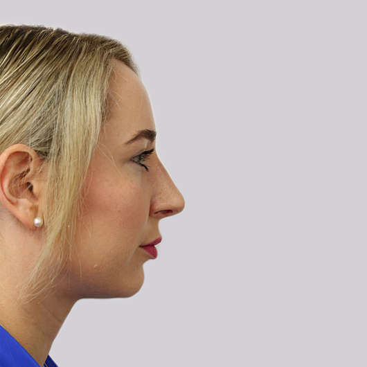 Dr Ha Rhinoplasty Before & After (Female) - Adelaide