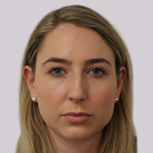 Dr Ha Rhinoplasty Before & After (Female) - Adelaide