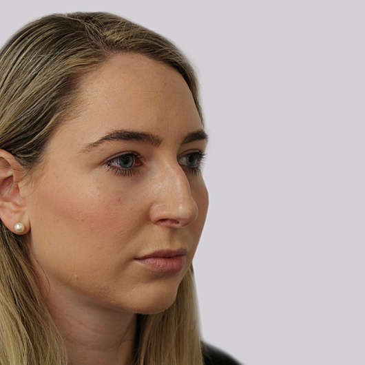 Dr Ha Rhinoplasty Before & After (Female) - Adelaide