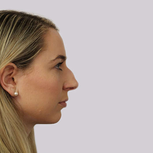 Dr Ha Rhinoplasty Before & After (Female) - Adelaide