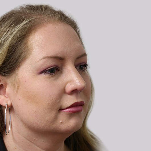 Dr Ha Rhinoplasty Before & After (Female) - Adelaide