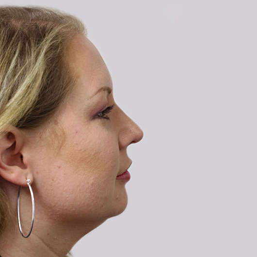 Dr Ha Rhinoplasty Before & After (Female) - Adelaide