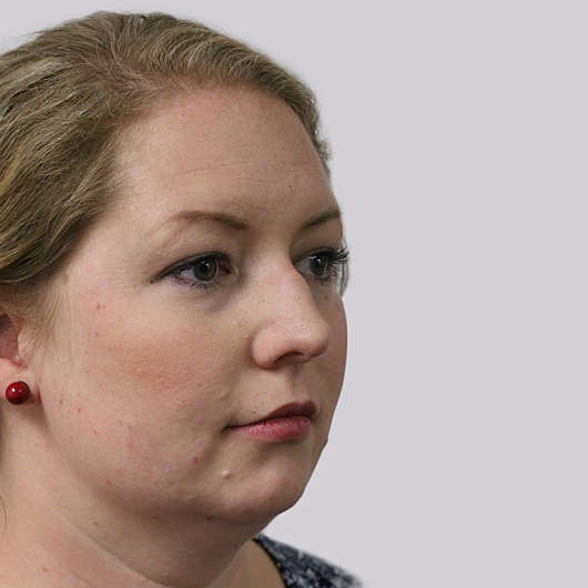 Dr Ha Rhinoplasty Before & After (Female) - Adelaide