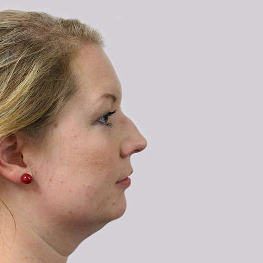Dr Ha Rhinoplasty Before & After (Female) - Adelaide