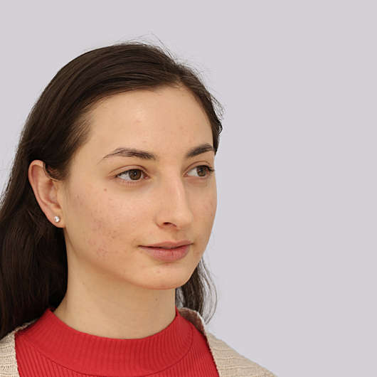 Dr Ha Rhinoplasty Before & After (Female) - Adelaide