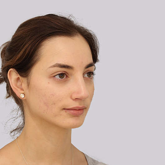 Dr Ha Rhinoplasty Before & After (Female) - Adelaide