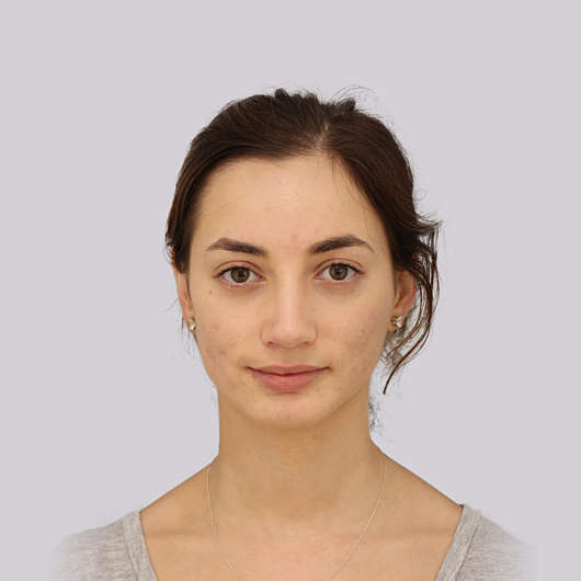 Dr Ha Rhinoplasty Before & After (Female) - Adelaide