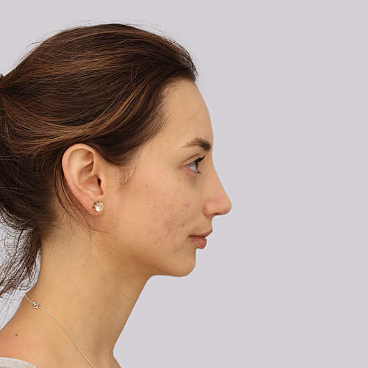 Dr Ha Rhinoplasty Before & After (Female) - Adelaide