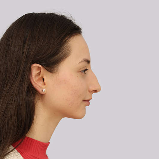 Dr Ha Rhinoplasty Before & After (Female) - Adelaide