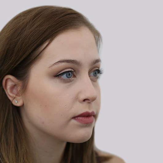 Dr Ha Rhinoplasty Before & After (Female) - Adelaide