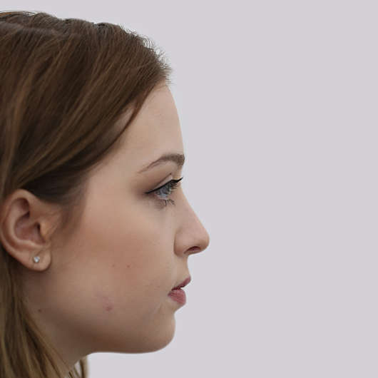 Dr Ha Rhinoplasty Before & After (Female) - Adelaide