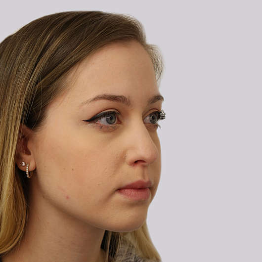 Dr Ha Rhinoplasty Before & After (Female) - Adelaide