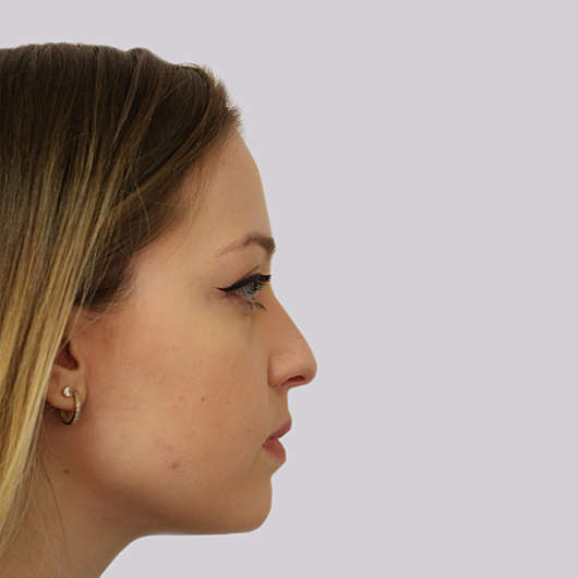 Dr Ha Rhinoplasty Before & After (Female) - Adelaide