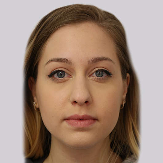 Dr Ha Rhinoplasty Before & After (Female) - Adelaide