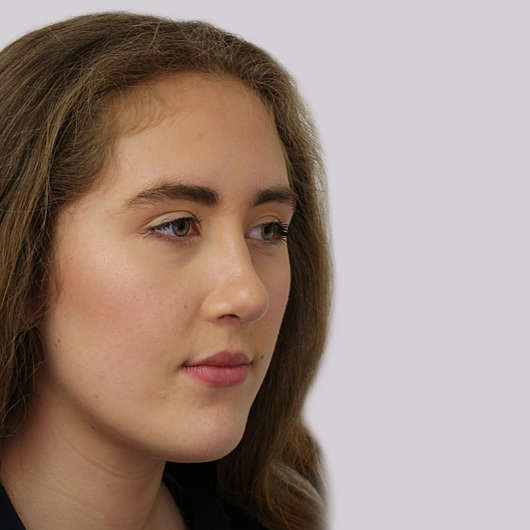 Dr Ha Rhinoplasty Before & After (Female) - Adelaide