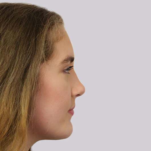Dr Ha Rhinoplasty Before & After (Female) - Adelaide