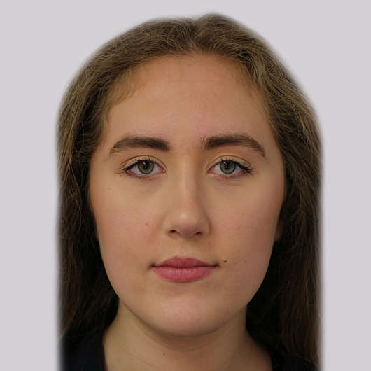 Dr Ha Rhinoplasty Before & After (Female) - Adelaide