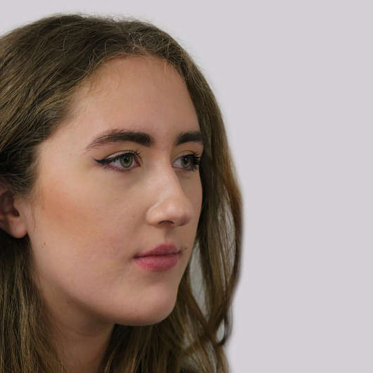 Dr Ha Rhinoplasty Before & After (Female) - Adelaide