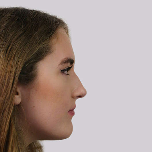 Dr Ha Rhinoplasty Before & After (Female) - Adelaide