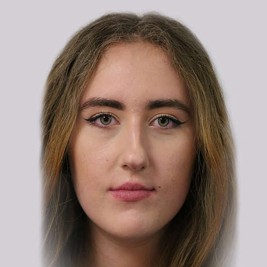 Dr Ha Rhinoplasty Before & After (Female) - Adelaide