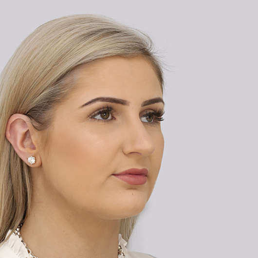 Dr Ha Rhinoplasty Before & After (Female) - Adelaide