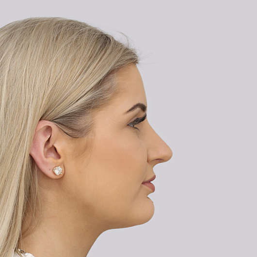 Dr Ha Rhinoplasty Before & After (Female) - Adelaide
