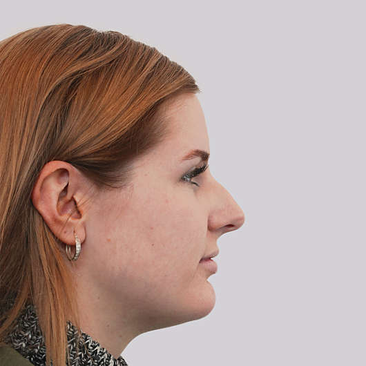 Dr Ha Rhinoplasty Before & After (Female) - Adelaide