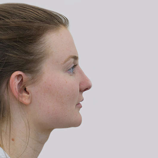 Dr Ha Rhinoplasty Before & After (Female) - Adelaide