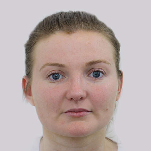 Dr Ha Rhinoplasty Before & After (Female) - Adelaide