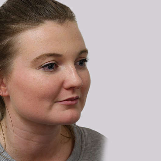 Dr Ha Rhinoplasty Before & After (Female) - Adelaide