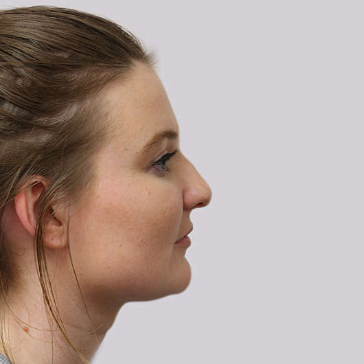 Dr Ha Rhinoplasty Before & After (Female) - Adelaide