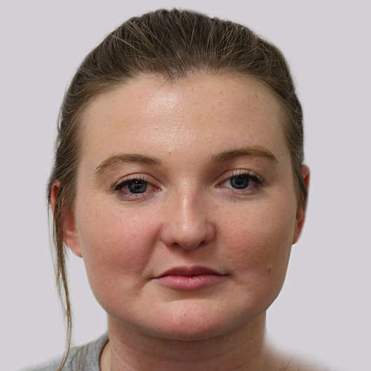 Dr Ha Rhinoplasty Before & After (Female) - Adelaide