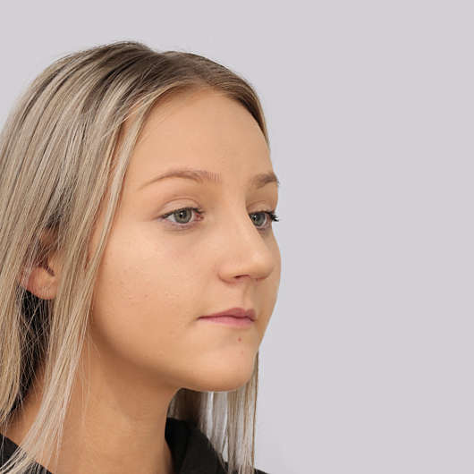 Dr Ha Rhinoplasty Before & After (Female) - Adelaide