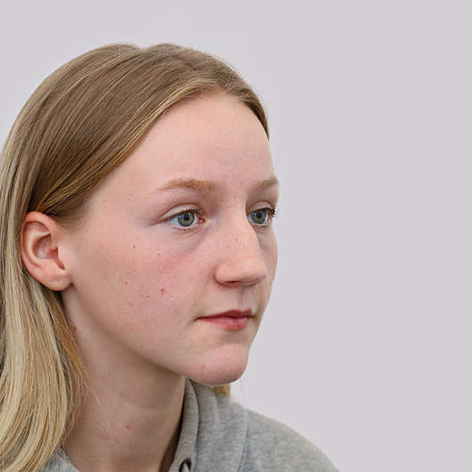 Dr Ha Rhinoplasty Before & After (Female) - Adelaide