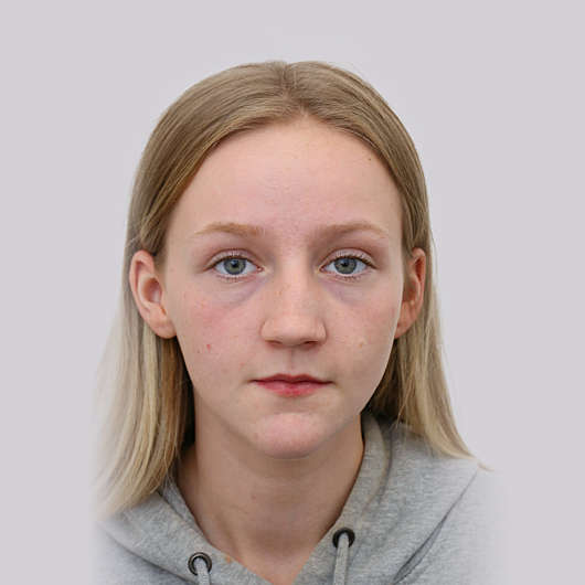 Dr Ha Rhinoplasty Before & After (Female) - Adelaide