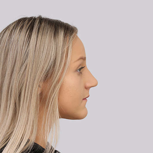 Dr Ha Rhinoplasty Before & After (Female) - Adelaide