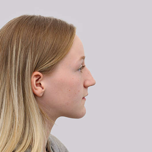 Dr Ha Rhinoplasty Before & After (Female) - Adelaide