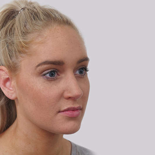 Dr Ha Rhinoplasty Before & After (Female) - Adelaide